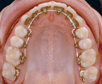Incognito Brackets