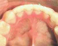 Retainer unterkiefer
